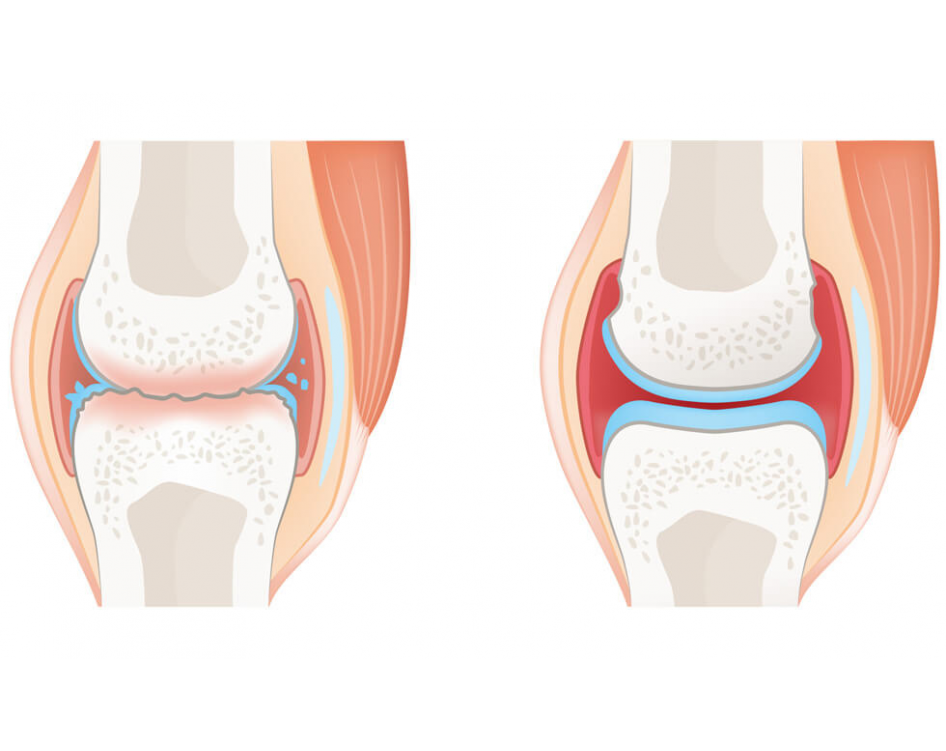 osteoarthritis ízületi gyulladás